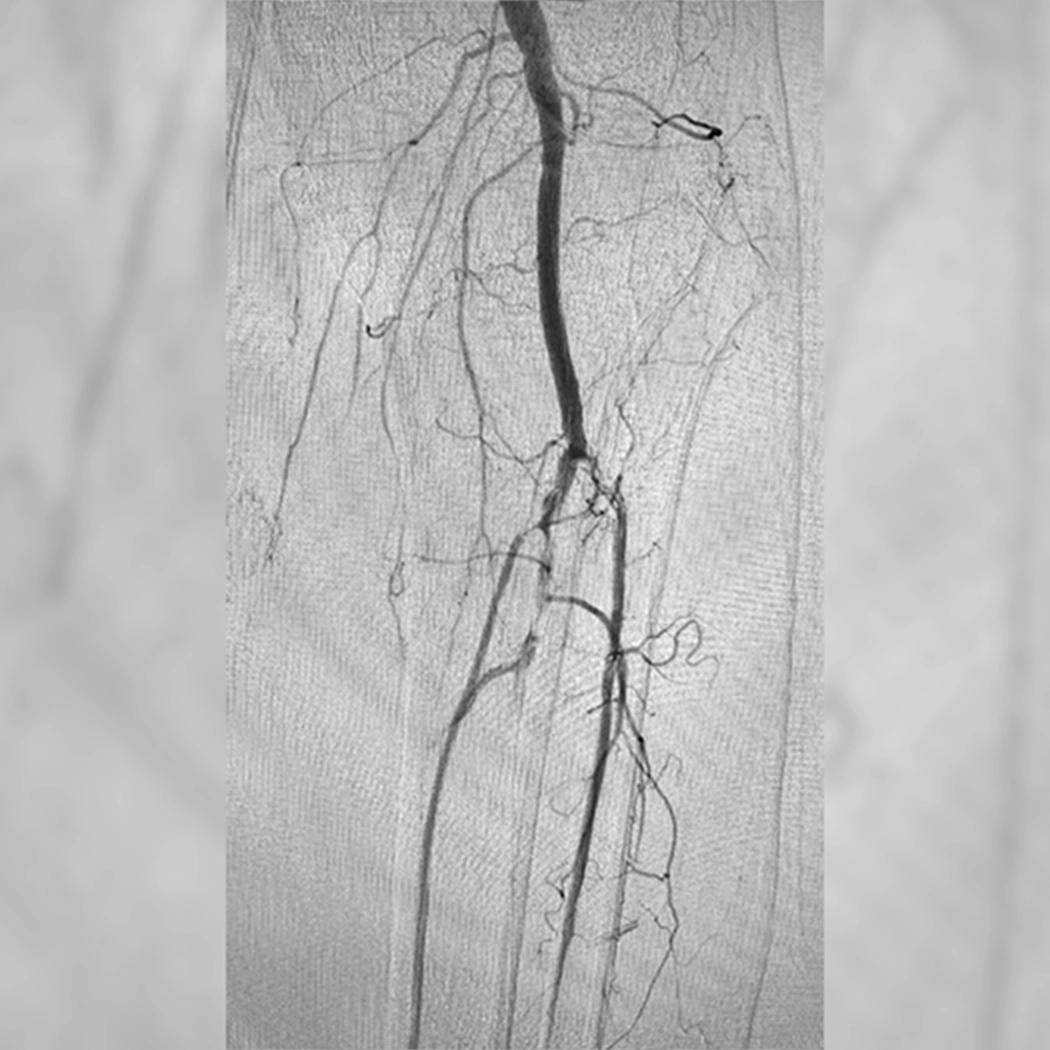 angiogram of occulated blood vessel