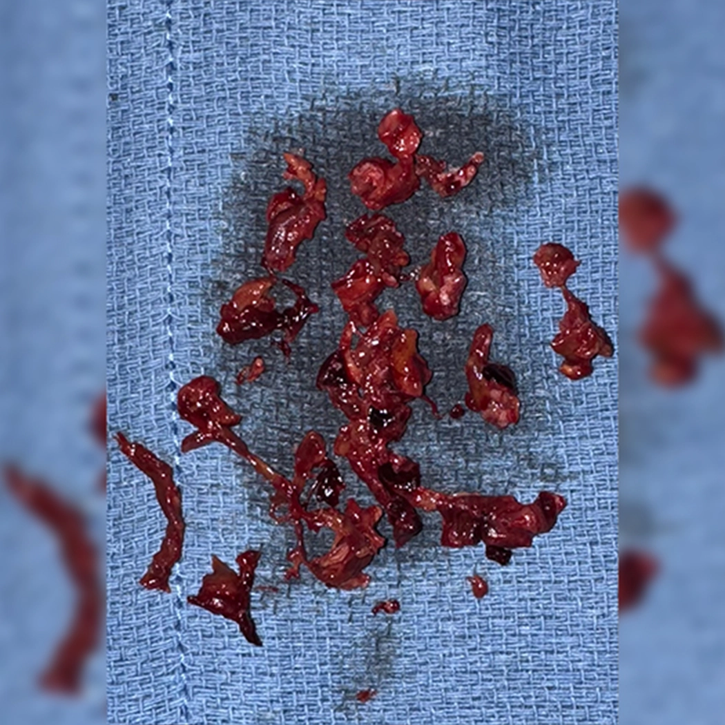 Blood clot removed using Computer Assisted Vacuum Thrombectomy