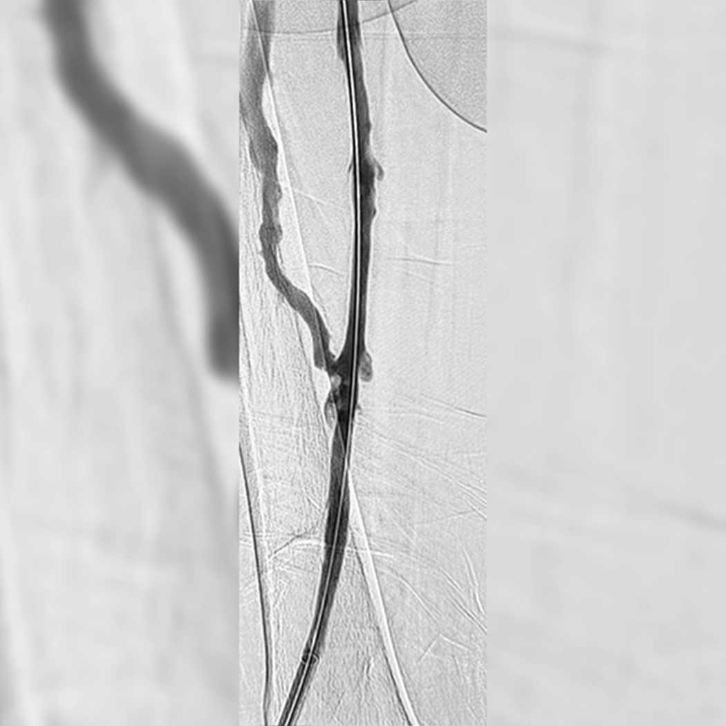 angiogram of cleared blood vessel