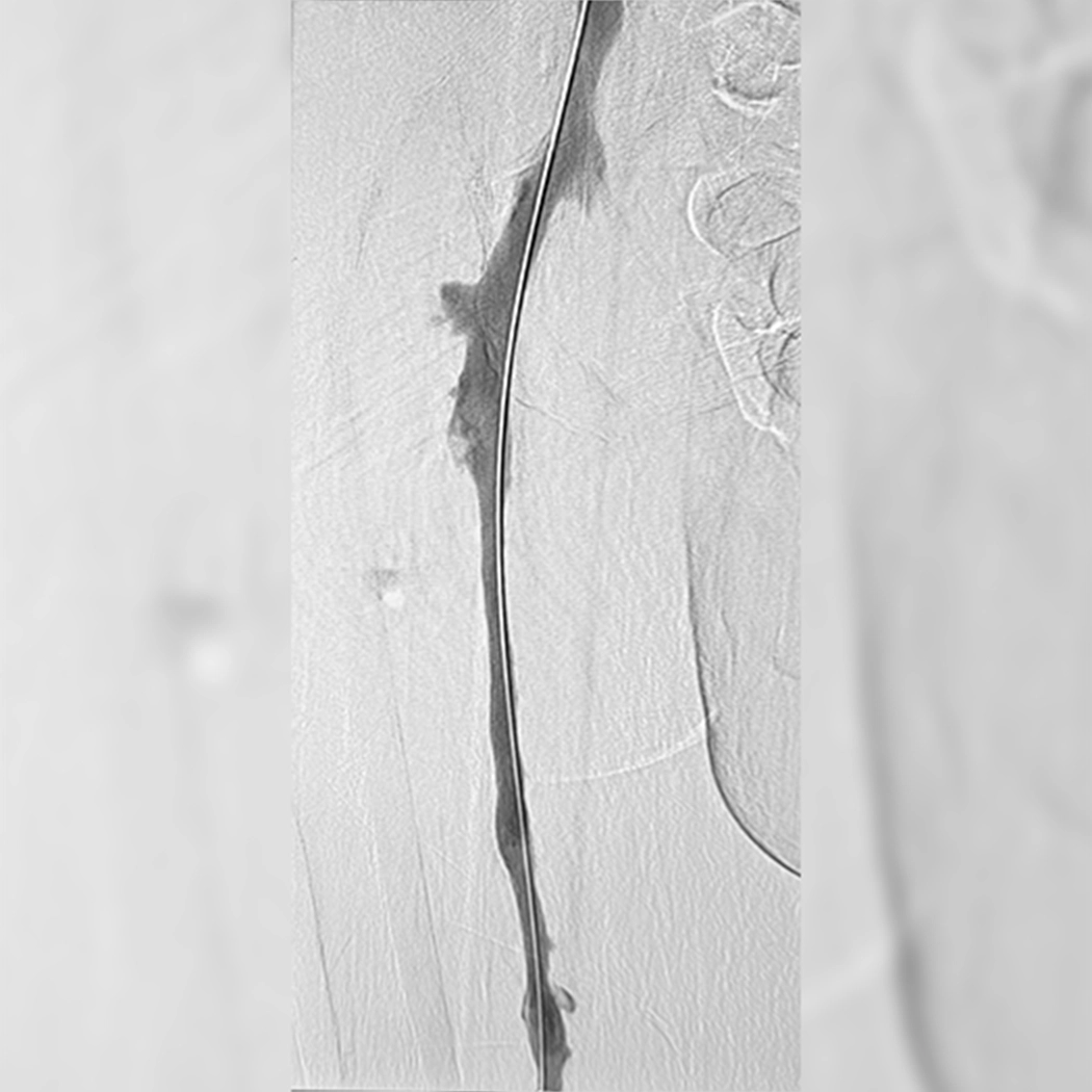 angiogram of cleared blood vessel