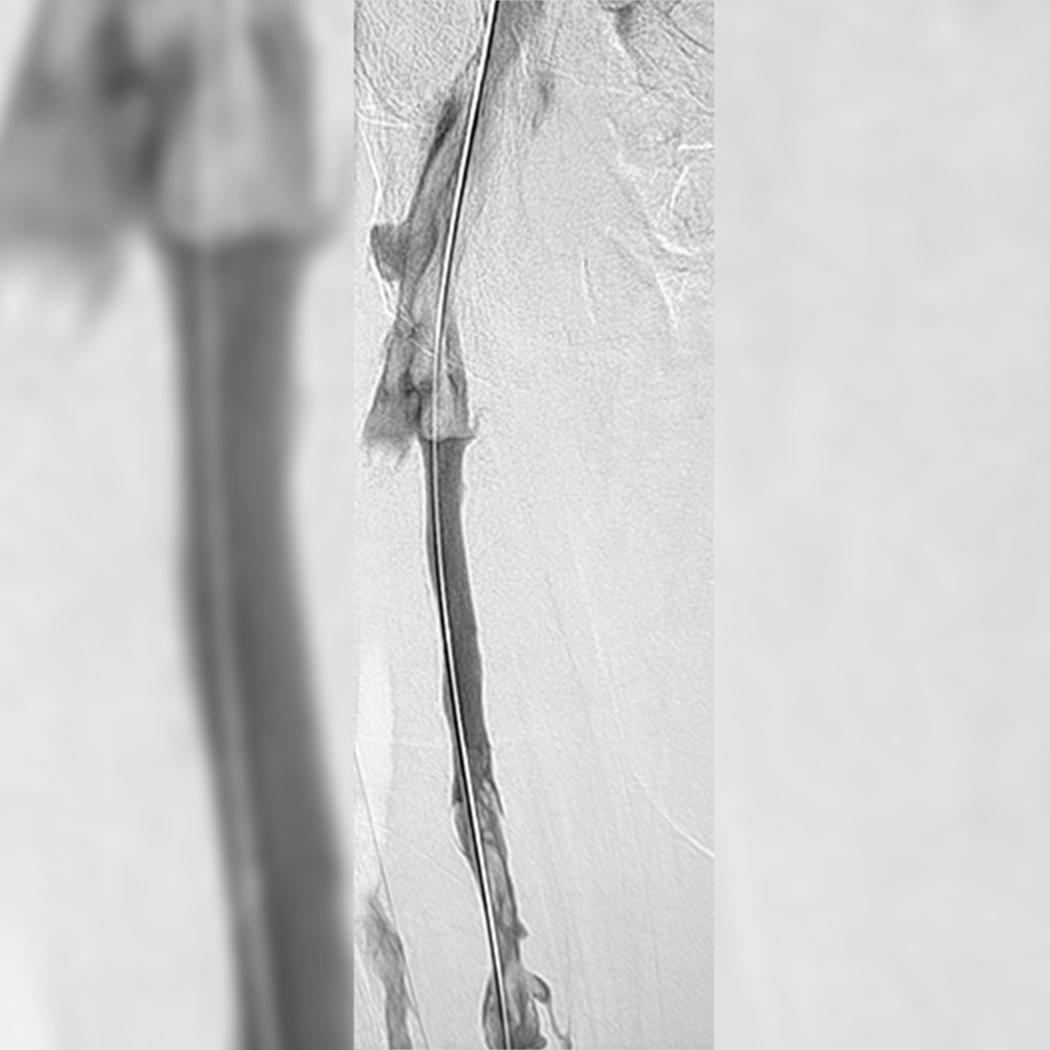 angiogram of occulated blood vessel