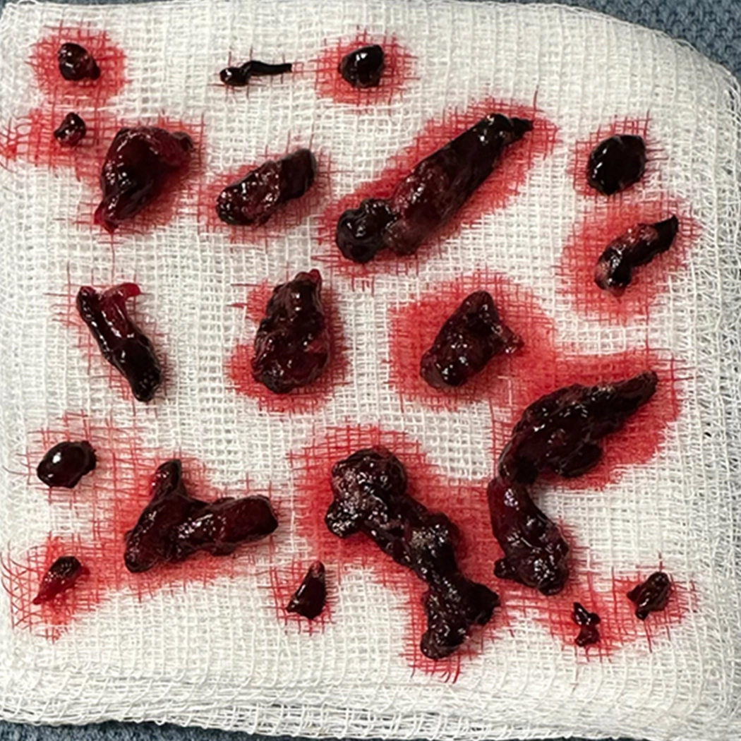 blood clot removed using Computer Assisted Vacuum Thrombectomy