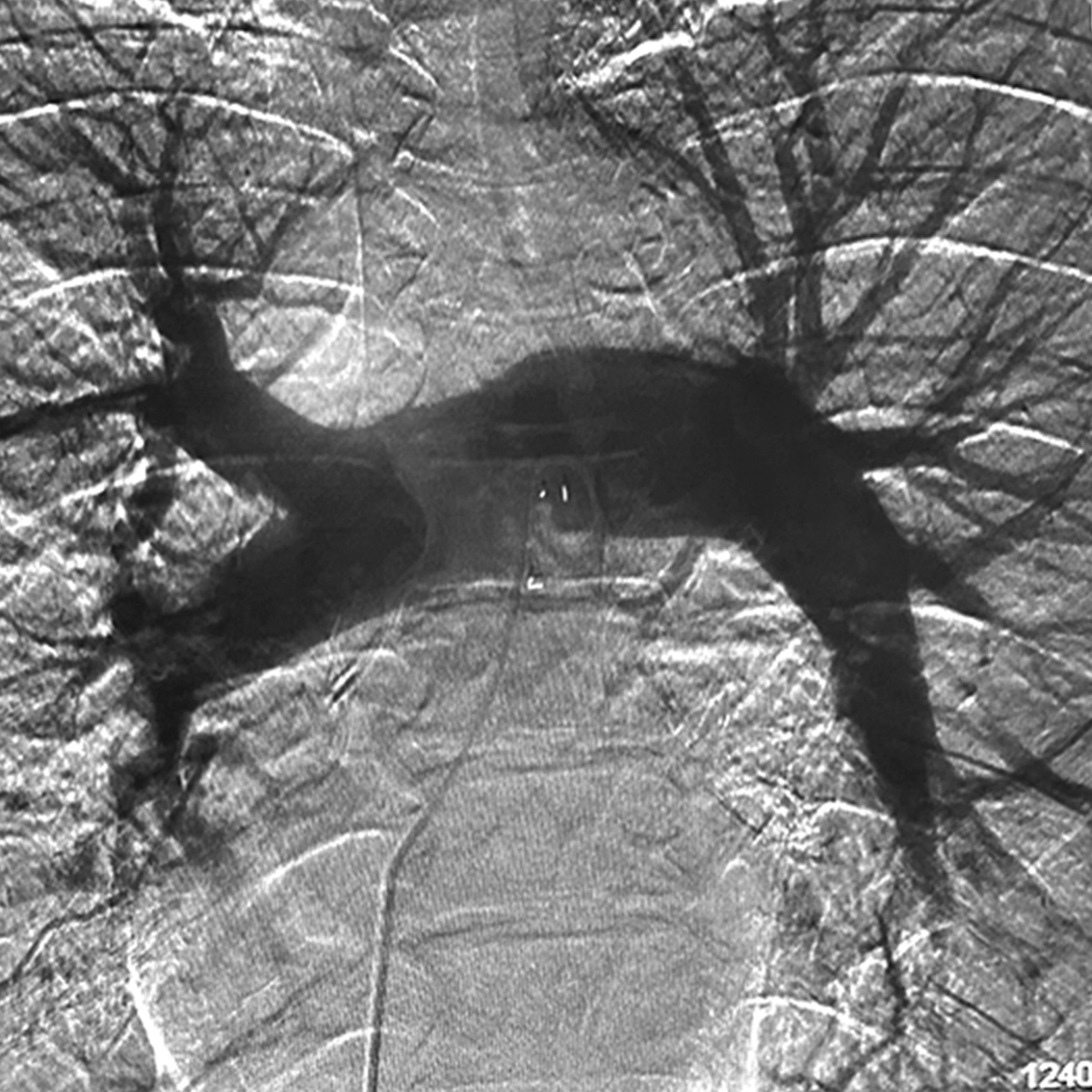 angiogram of bilateral cleared blood vessel in both the lungs