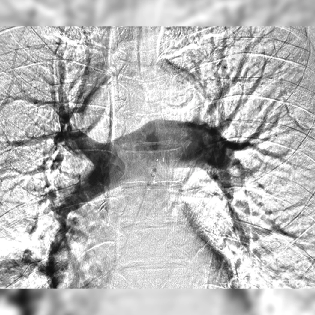 angiogram of bilateral occulated blood vessel in both the lungs