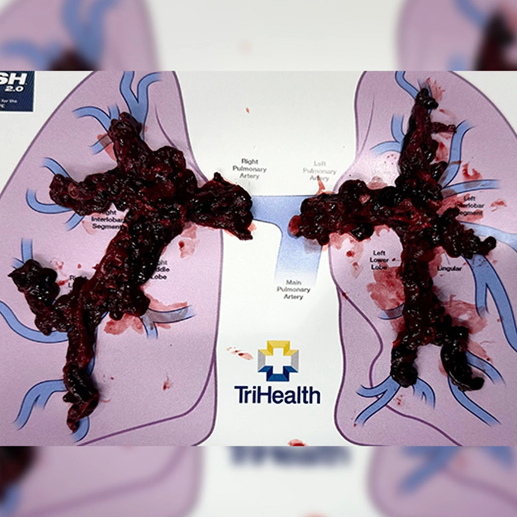 blood clot removed using Computer Assisted Vacuum Thrombectomy