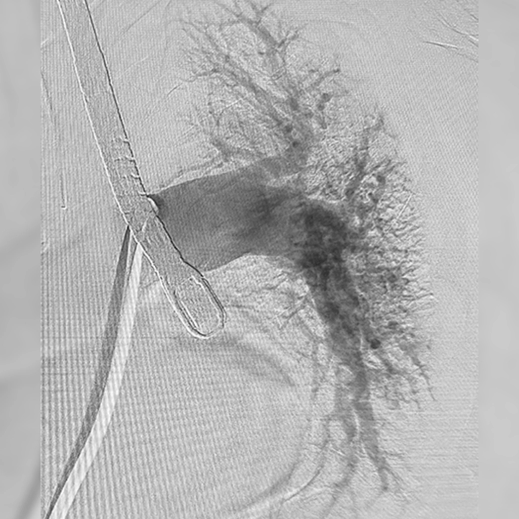 angiogram of cleared blood vessel in left lung