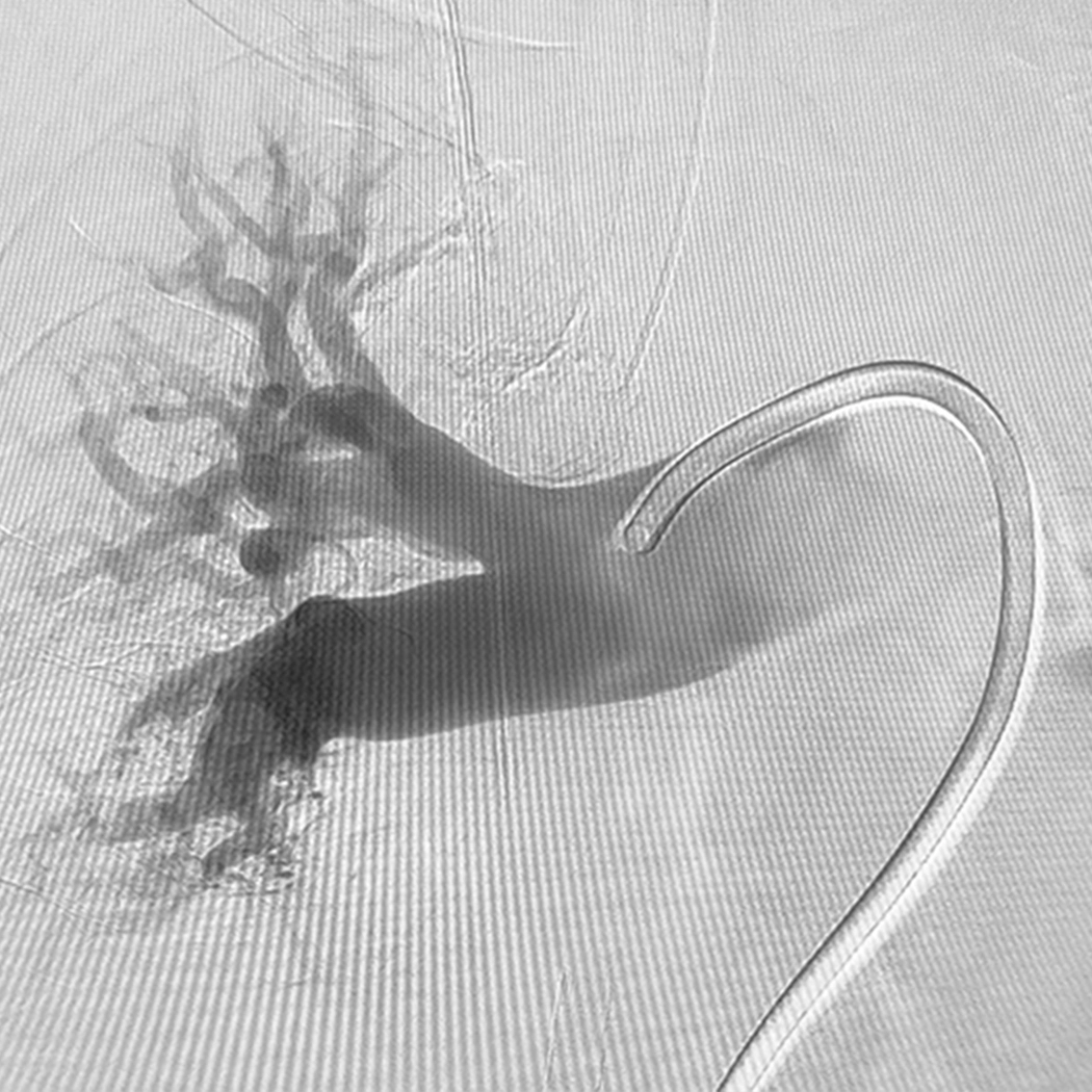 angiogram of cleared blood vessel in right lung