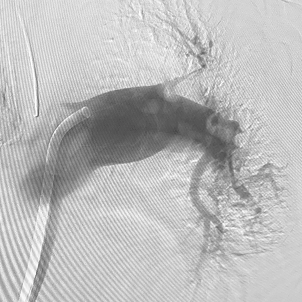 angiogram of occulated blood vessel in left side