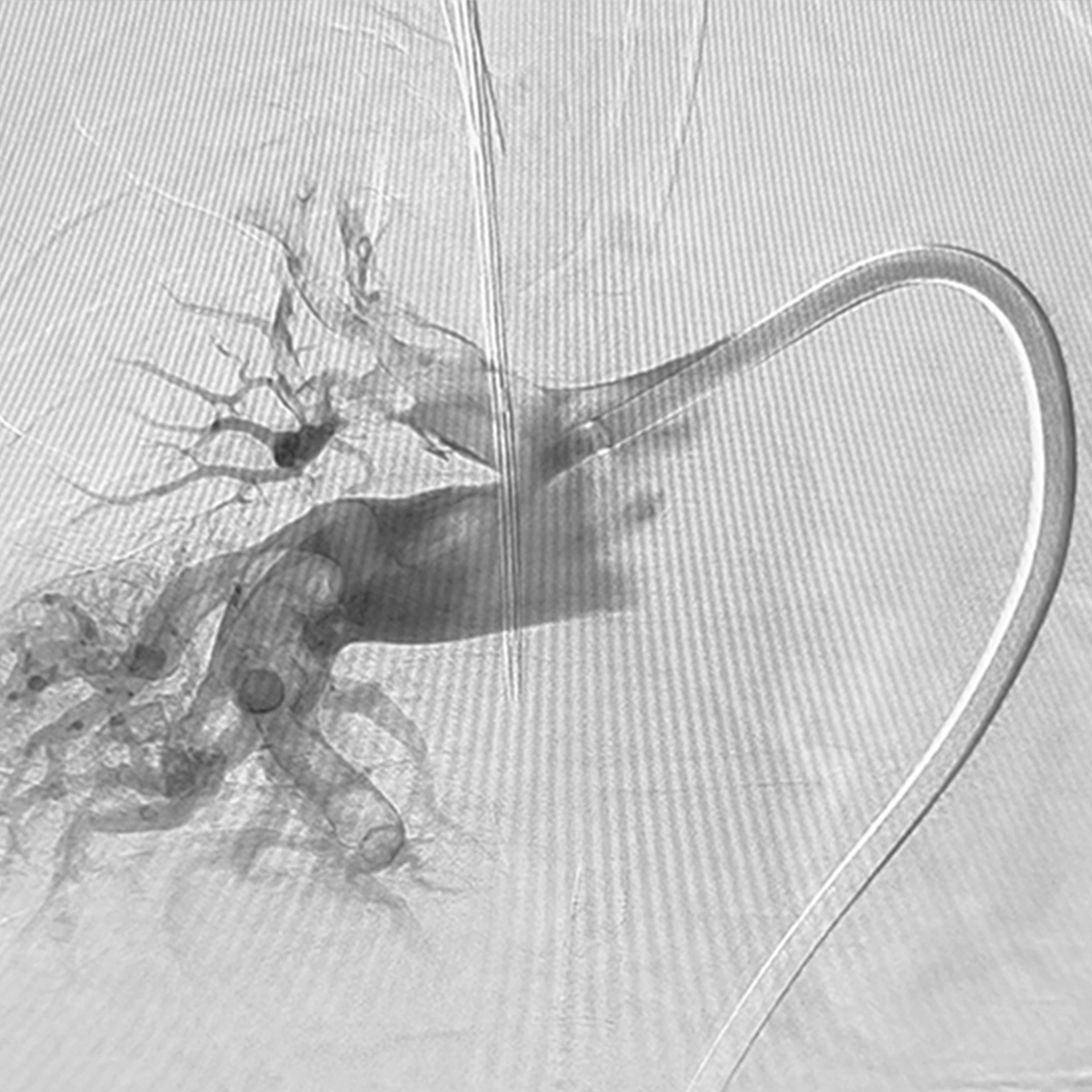 angiogram of occulated blood vessel in right lung