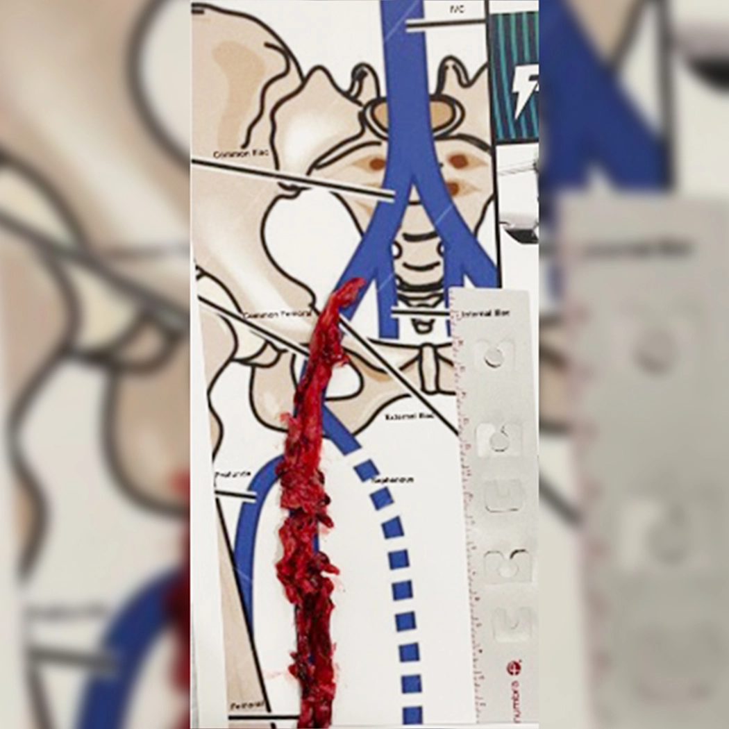Blood clot removed using Computer Assisted Vacuum Thrombectomy