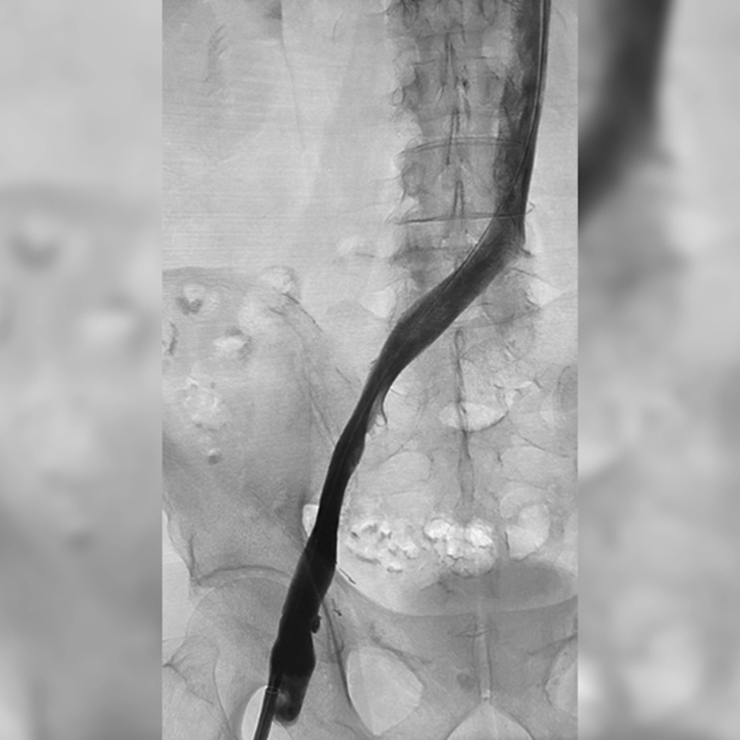angiogram of cleared blood vessel