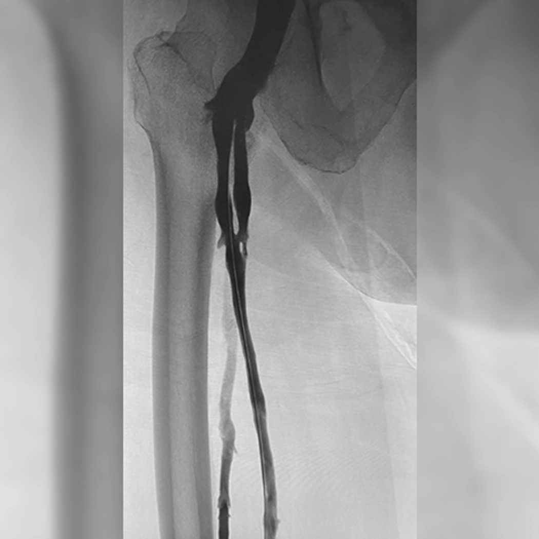 angiogram of cleared blood vessel
