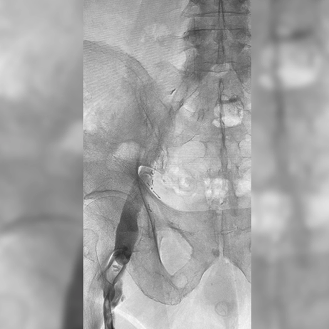 angiogram of occulated blood vessel