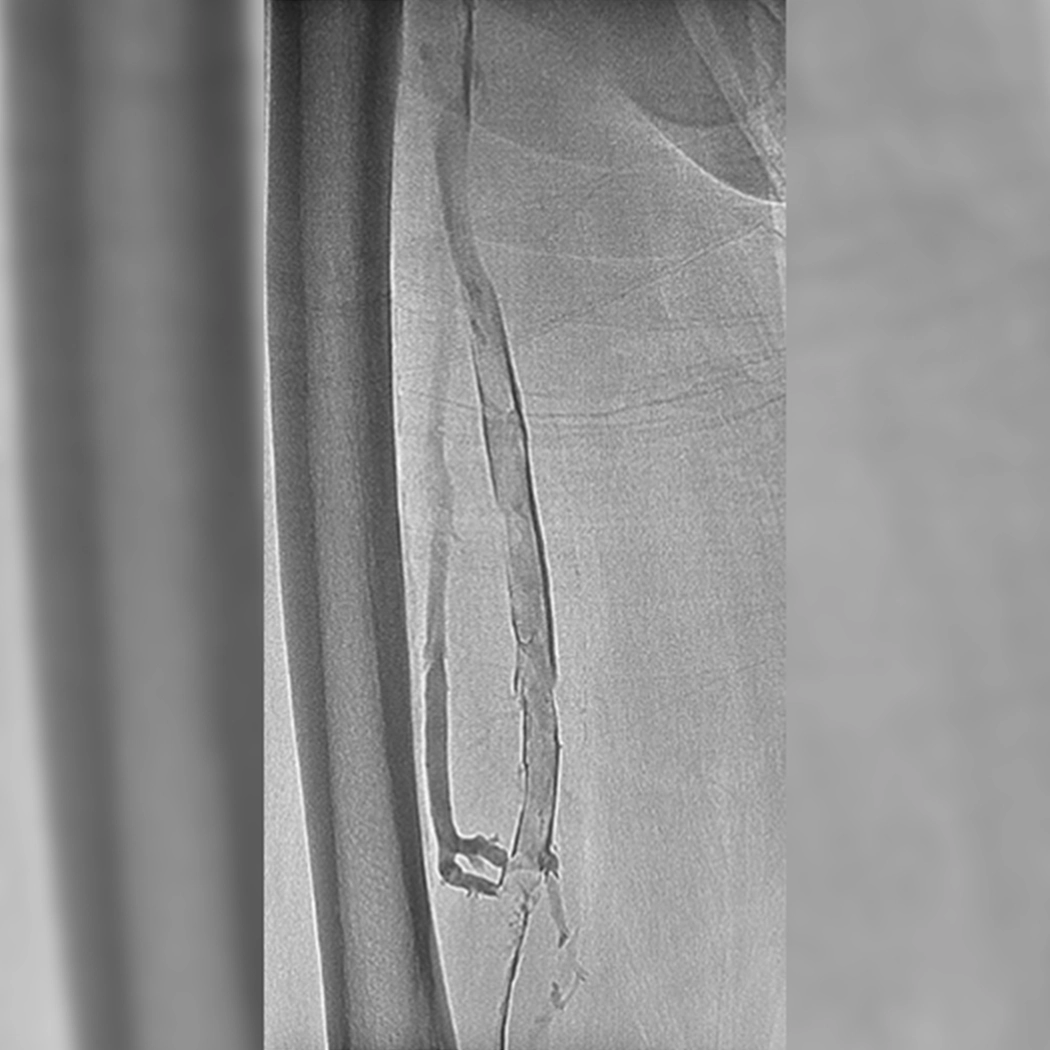 angiogram of occulated blood vessel