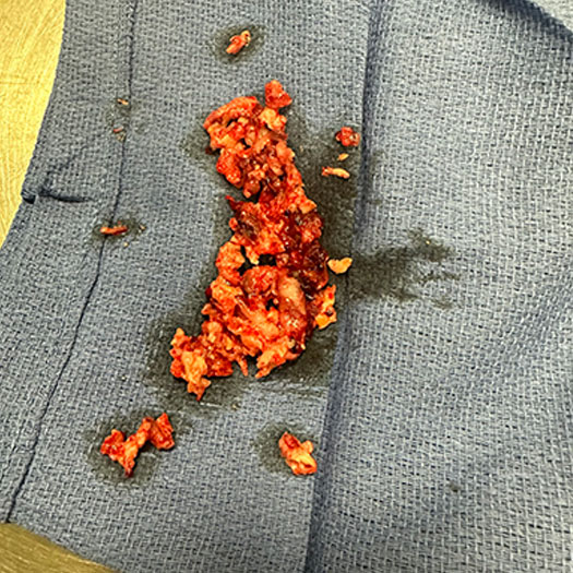 blood clot from Caval and Inferior Vena Cava