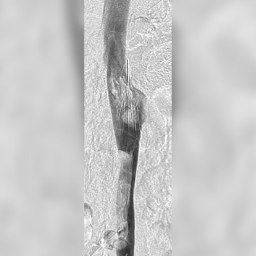 angiogram of cleared Caval and Inferior Vena Cava