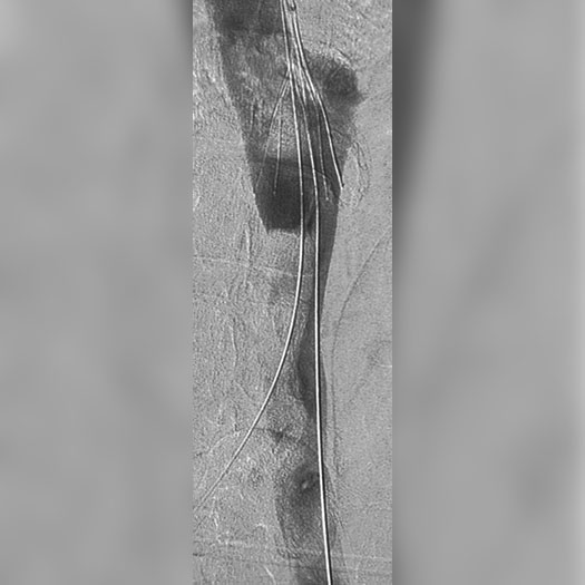 angiogram of occluded Caval and Inferior Vena Cava