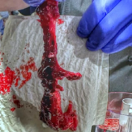 blood clot from upper extremity