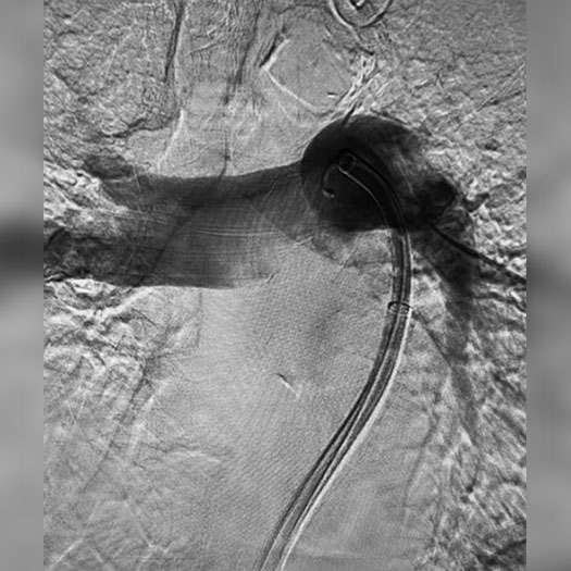 angiogram of occluded blood vessel in the lung