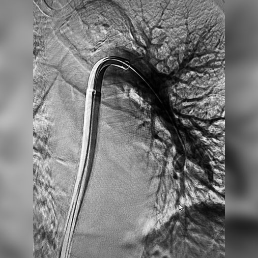 angiogram of cleared blood vessel in the lung