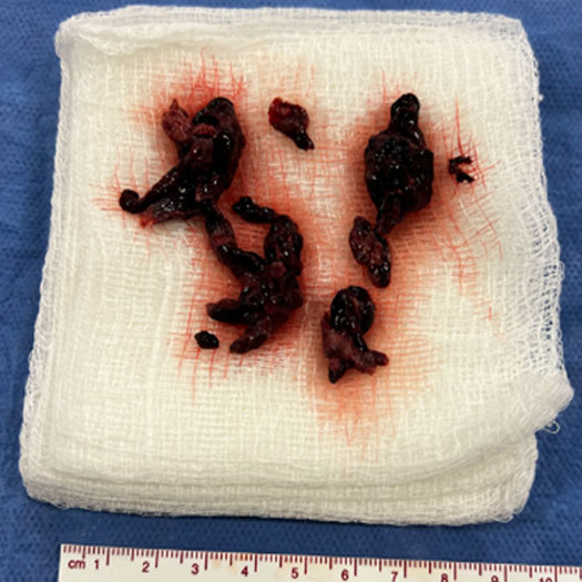blood clot form left-sided pulmonary embolism