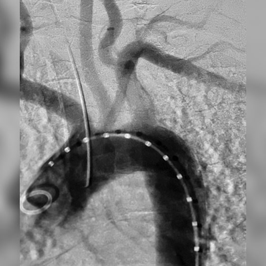 angiogram of occluded subclavian artery