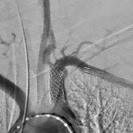 angiogram of cleared subclavian artery