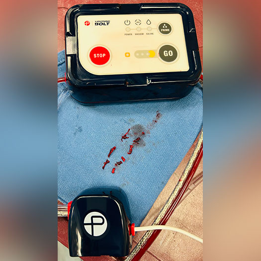 blood clot from iliac artery on blue gauze pad