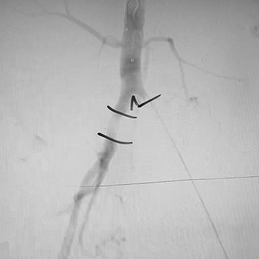 angiogram of occluded iliac artery