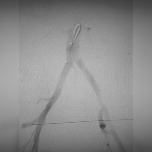 angiogram of occluded iliac artery
