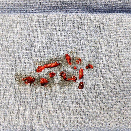 blood clot from superior mesenteric artery