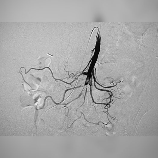 angiogram of occluded superior mesenteric artery