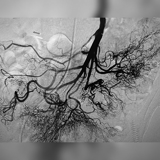angiogram of occluded superior mesenteric artery