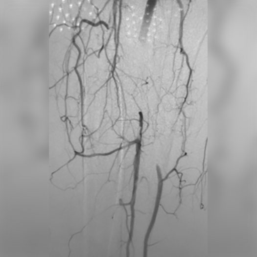 angiogram of occluded superficial femoral artery to posterior tibial artery bypass