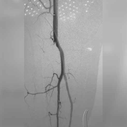 angiogram of cleared superficial femoral artery to posterior tibial artery bypass