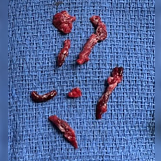 blood clot from superficial femoral artery to posterior tibial artery bypass