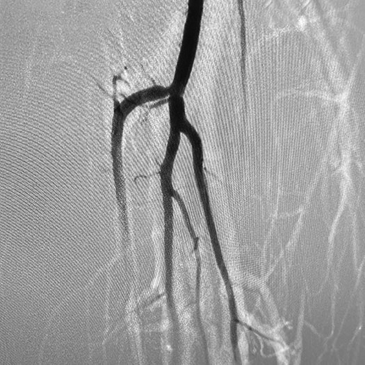 angiogram of occluded superficial femoral artery to posterior tibial and anterior tibial trunks