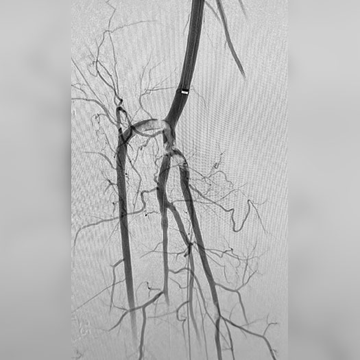 angiogram of occluded superficial femoral artery to posterior tibial and anterior tibial trunks