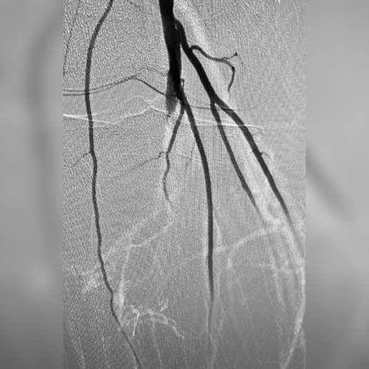 angiogram of occluded superficial femoral artery to posterior tibial and anterior tibial trunks