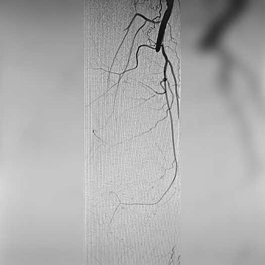angiogram of occlusion in hunter's canal