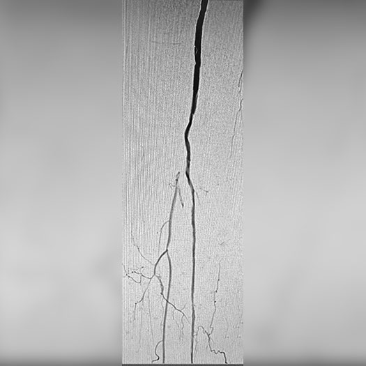 angiogram of cleared hunter's canal