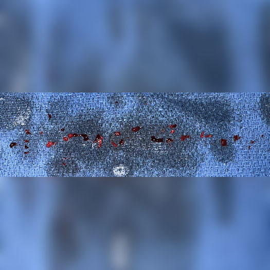 blood clot from hunter's canal on blue gauze pad