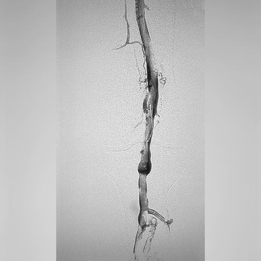 angiogram of occluded popliteal vein