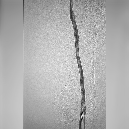 angiogram of cleared popliteal vein