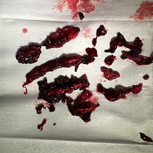 blood clot from popliteal vein