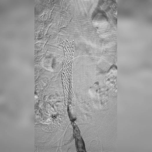 catheter access and stent in iliofemoral vein