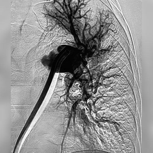 angiogram of occluded blood vessel in both the lungs