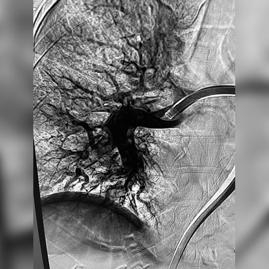 angiogram of occluded blood vessel in both the lungs