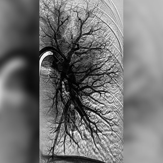 angiogram of cleared blood vessel in both the lungs