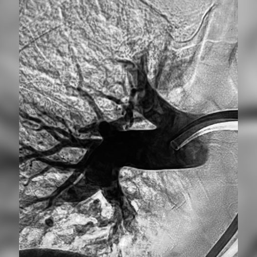 angiogram of cleared blood vessel in both the lungs